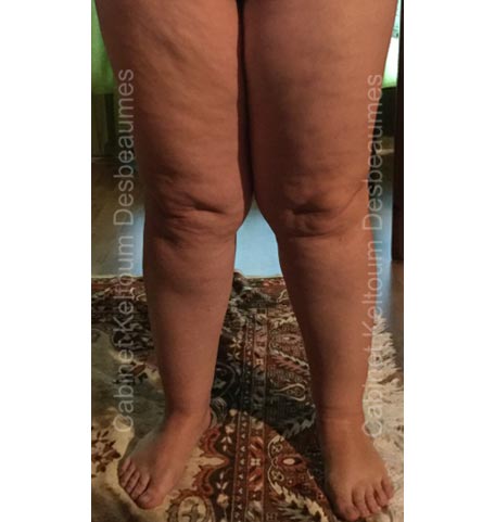 Illustration du lipoedème
